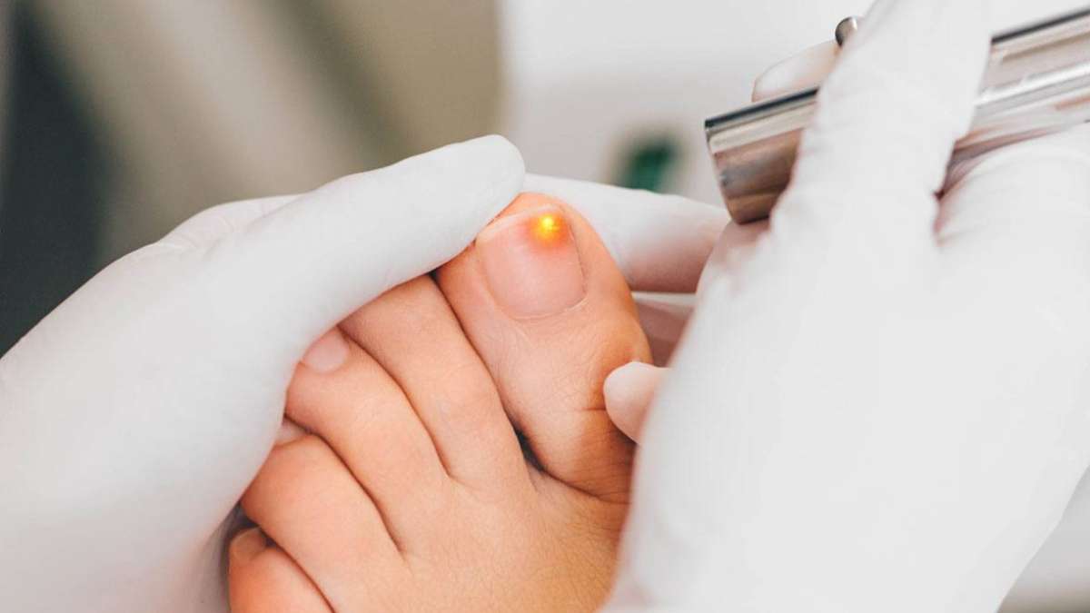 A Toenail Fungus At The Peak Of The Infection. Painful Toe Contagious With  Onychomycosis. Active Phase Of The Disease. Untreated Onychomycosis Of The  Feet. Stock Photo, Picture and Royalty Free Image. Image